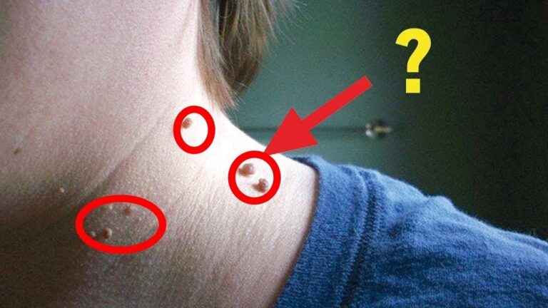 Scopri 5 modi rapidi per rimuovere gli inestetismi della pelle!