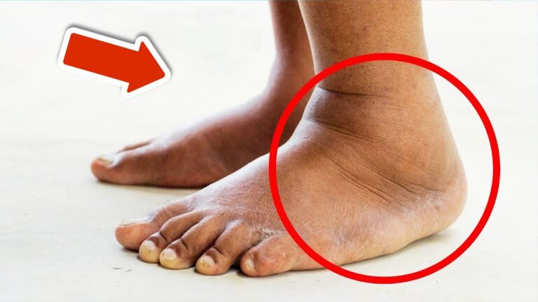 Rimuovi gonfiori da gambe e piedi in 5 mosse incredibilmente veloci!