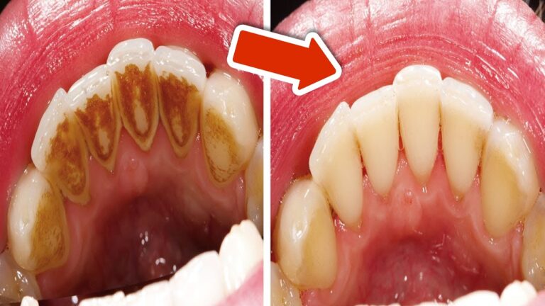 Rimuovi il tartaro in 5 semplici passi senza andare dal dentista!