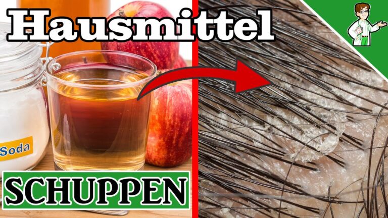 7 rimedi naturali contro le squame dei capelli: scopri i migliori!