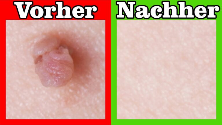 Scopri 5 rimedi naturali per eliminare rapidamente gli occhiali di pelle!