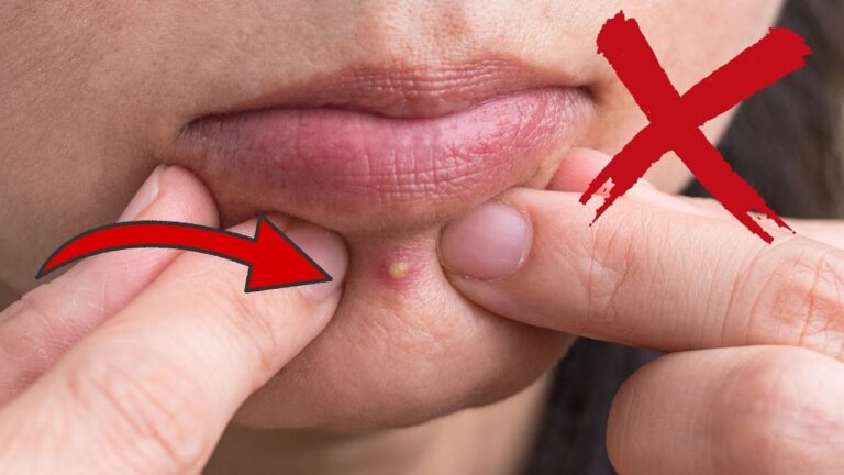 Scopri 5 posti dove mai esprimere un brufolo per evitare danni alla pelle!
