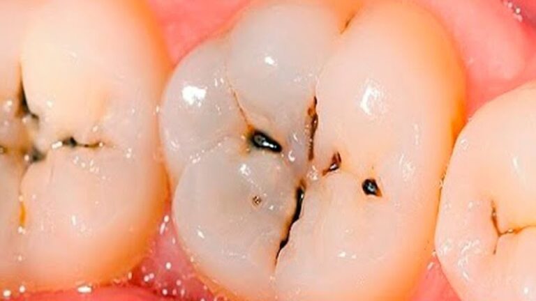 5 Segreti per Combattere la Carie e Avere Denti Sani Subito