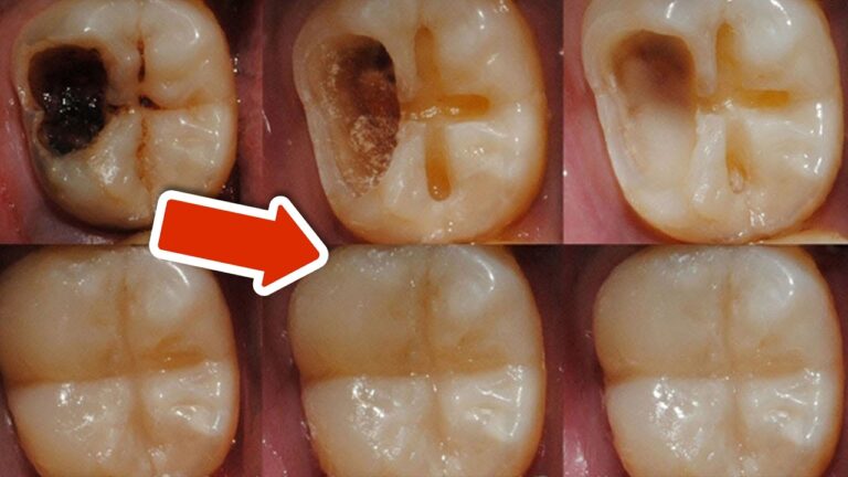 Scopri 5 segreti per combattere il dolore dentale e fermare il tuo problema!