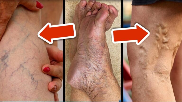 Scopri i 3 benefici sorprendenti del miglior vitamina per combattere le varici!